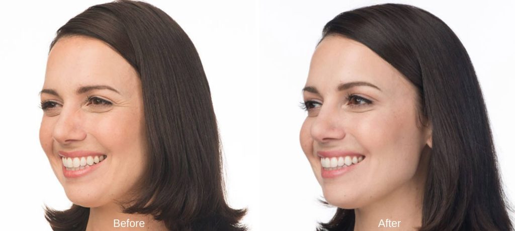 Botox Face Slimming in Turkey